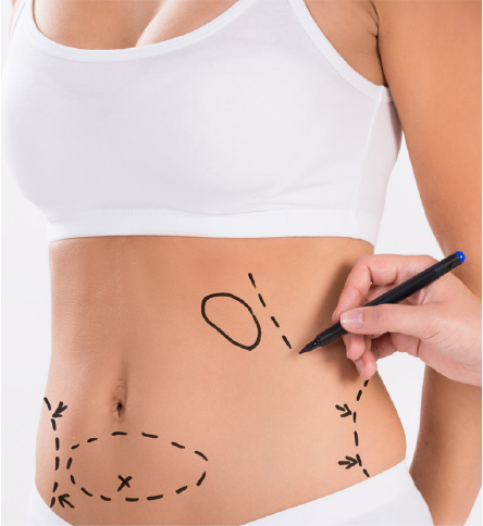 ABDOMINOPLASTIE