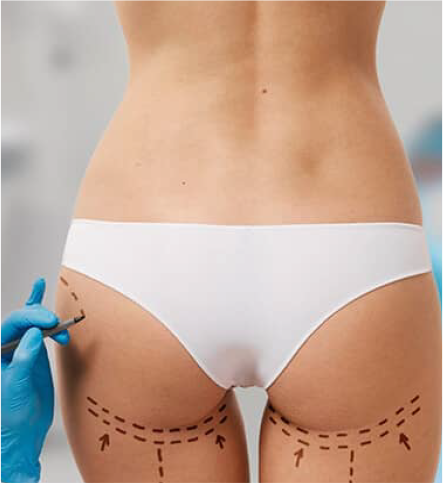 LIPOFILLING DES FESSES